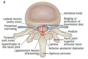 Lumbar Spinal Stenosis Diagnose Behandeling Voor Fysio S