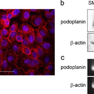 Gene And Protein Level Expression Of Podoplanin In Pleomorphic Adenoma