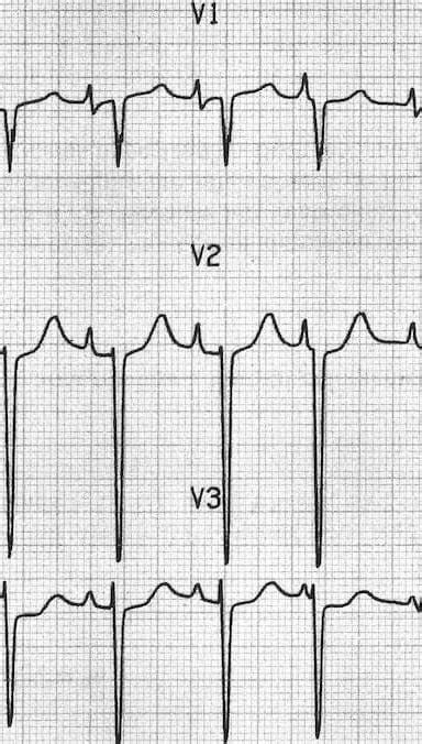 Right Atrial Enlargement • LITFL Medical Blog • ECG Library Basics