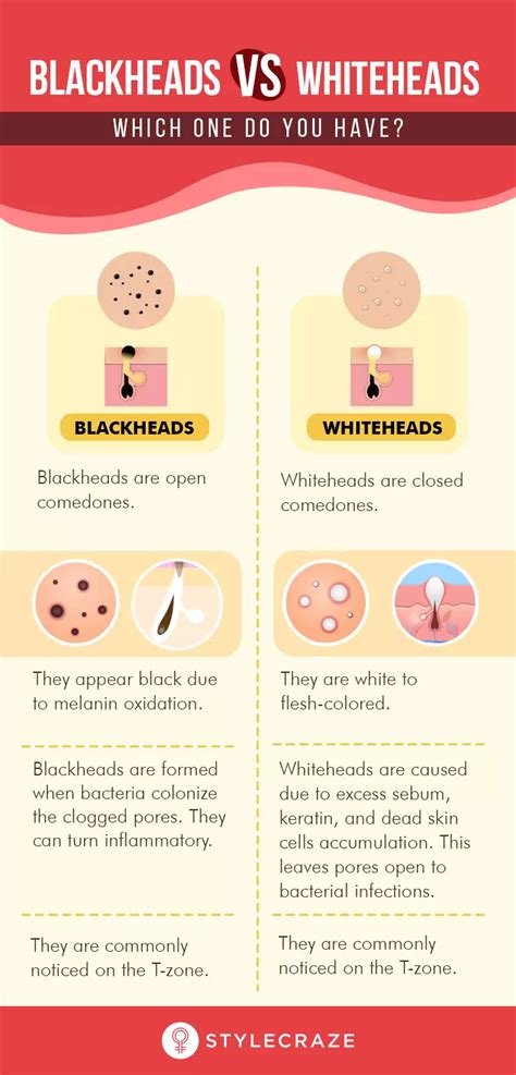 Whiteheads Vs. Blackheads: Difference, Treatment & Prevention