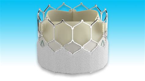 Fda Oks Edwards Sapien 3 Ultra Transcatheter Heart Valve