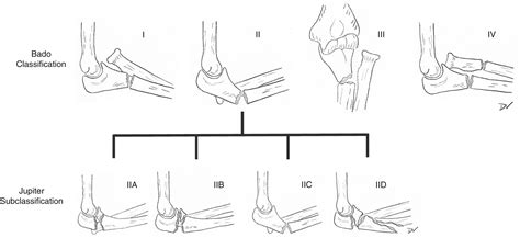 Proximal Ulna Fractures And Fracture Dislocations—monteggia And Beyond