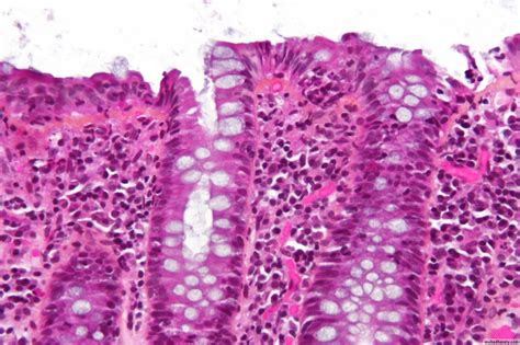 Acute Inflammation Pptx Muhadharaty