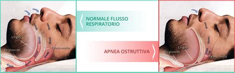 Apnea Del Sonno Osas Diagnosi Sintomi E Cure