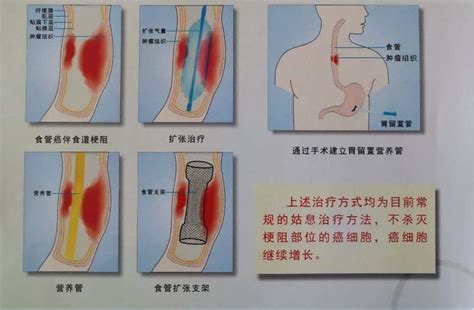 中晚期食管癌患者新的曙光 内镜下化疗粒子植入靶向介入新技术 微医（挂号网）