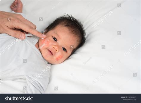 2,954 Baby face rash Images, Stock Photos & Vectors | Shutterstock