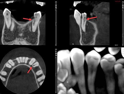 What is Root Resorption? Can it Be Fixed? - | Charlotte Root Canal Dentist