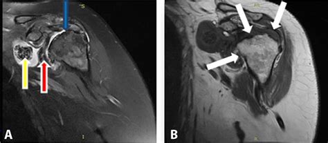 Osteochondromatosis Of The Shoulder With Massive Rotator Cuff Tear And