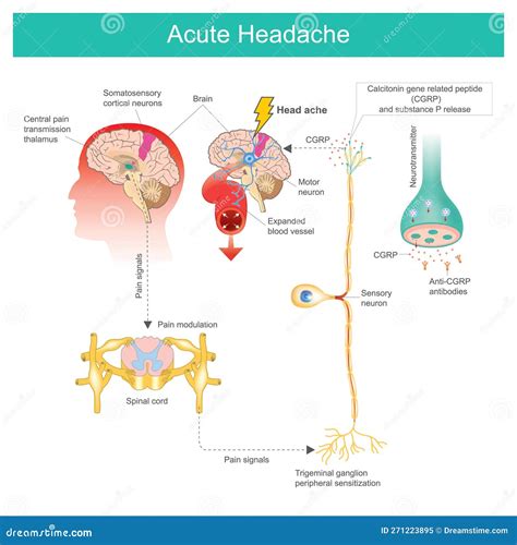 Acute Headache. Diagram Learning The Acute Headache As A Result A Process Of The Brain And