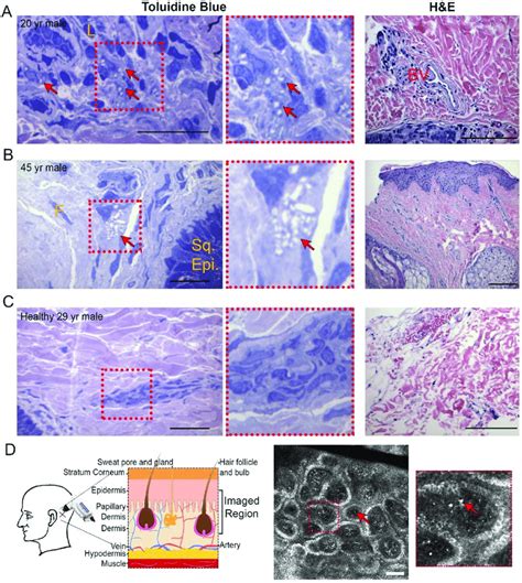 Skin Biopsies And Intradermal Confocal Imaging Highlight Crystals In