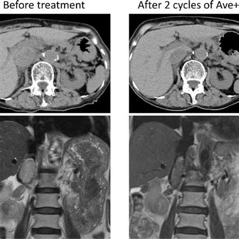 Computed Tomography CT And Magnetic Resonance Imaging MRI Findings