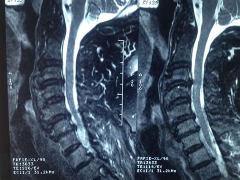 DISH: Diffuse Idiopathic Skeletal Hyperostosis of the spine