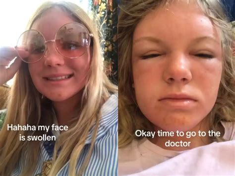 A Womans Horrific Sunburn Is Teaching People About Sun Poisoning And