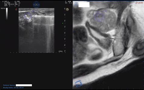 Mri Screening And Mri Us Fusion Guided Transperineal Biopsy In