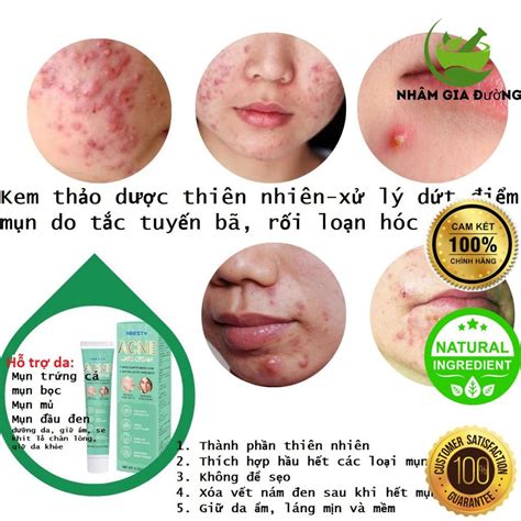 Acne Cream, Red Acne, Blackheads, Pustules... Herbal Ingredients 100% _ HBESTY | Shopee Malaysia