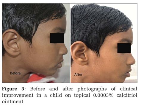 A Double Blind Randomized Controlled Trial Comparing The Efficacy Of