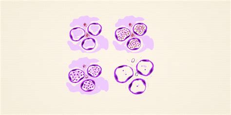 Pathology of Lobar Pneumonia - Pathology Made Simple