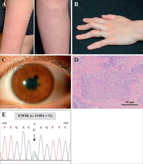 Jle European Journal Of Dermatology Exacerbation Of Symptoms In