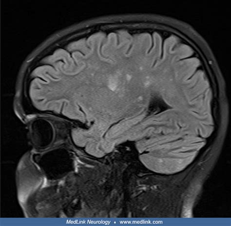 Susac Sydrome Admission Mri Showing Lesions In Periventricular And