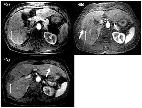 Poor Prognosis in HBV-associated Hepatocellular Carcinoma After ...