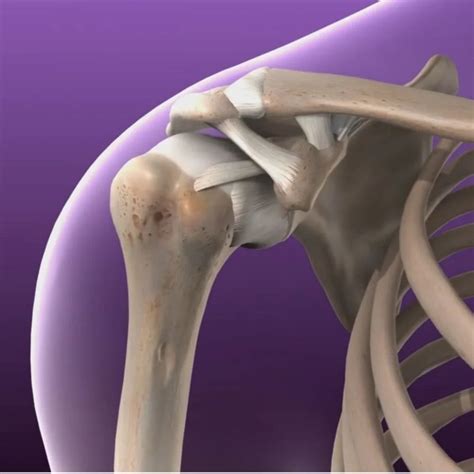 Recurrent Shoulder Dislocation Repair Dr Ishan Shevate