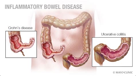 Mayo Clinic Q And A Treating Inflammatory Bowel Disease Mayo Clinic