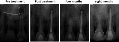 Management Of Internal Root Resorption In The Maxillary Central Incisor