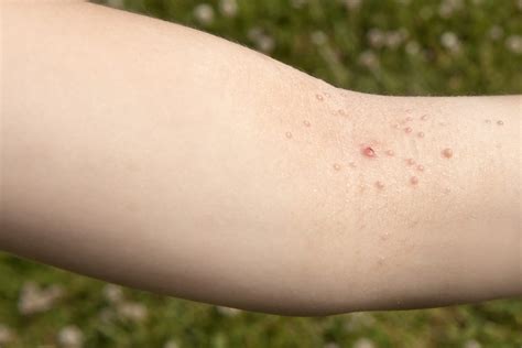 Molluscum Contagiosum Symptoms Treatment And Causes Myhealthcare Clinic