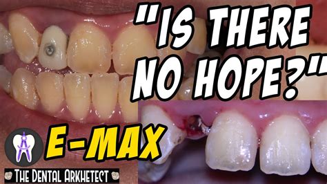 Restoring A Heavily Fractured Tooth With A Post And E Max Crown C