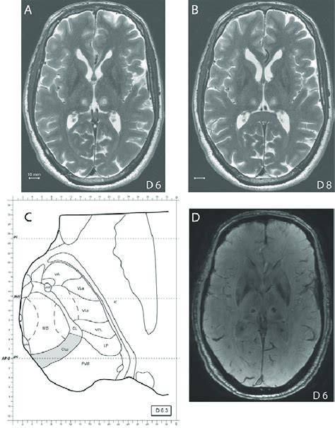 Axial T2 Weighted Mr Images A And B Obtained 2 Days After Treatment