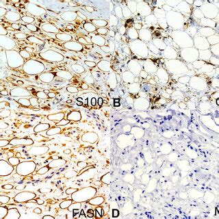 Photomicrographs Of The Surgical Specimen Immunohistochemical Analysis