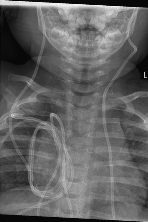 Intrathoracic Migration Of Subduroperitoneal Shunt Image