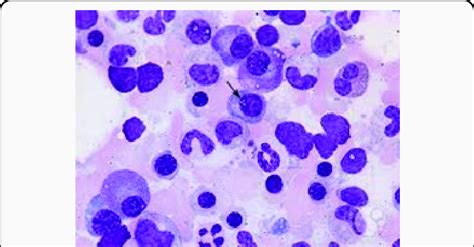 wm  presence  intra nuclear inclusions termed  dutchers body