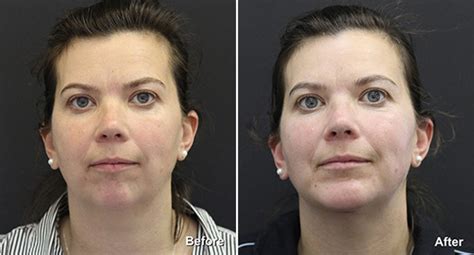 Chin Implants Photos | Philadelphia, PA | Patient 838