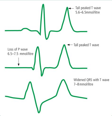 Journal Of Paramedic Practice Identifying And Managing Hyperkalaemia