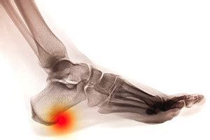 Heel Spurs Causes Symptoms Diagnosis And Treatment