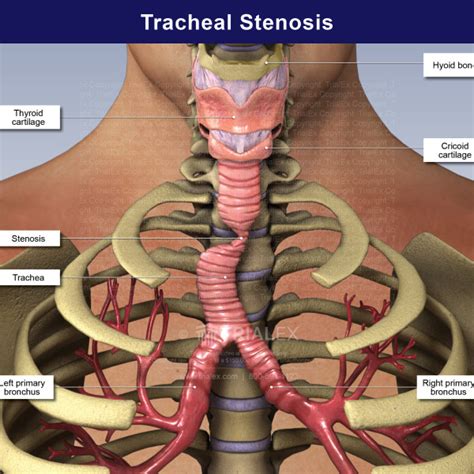 Medical Legal Exhibits Legal Animations Trial Graphics Tria