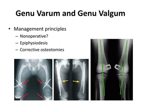 Ppt Common Pediatric Lower Limb Disorders Powerpoint Presentation