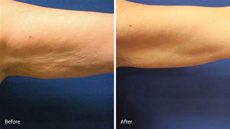 Laser Skin Tightening: How It Works, Results, Risks and Cost