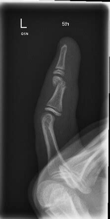 Middle phalanx fracture | Radiology Case | Radiopaedia.org