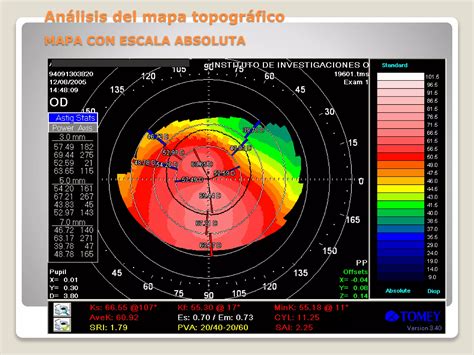 Interpretación básica de la Topografía Corneal PPT