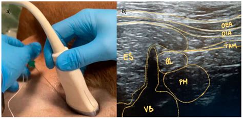 Ultrasound US Guided Quadratus Lumborum QL Block At The Level Of