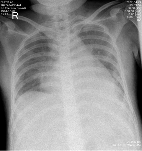 Chest X Rays Showed Cardiomegaly Download Scientific Diagram