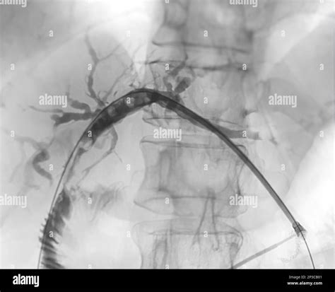 X Ray Image Of Portal Vein After Doctor Doing Ercp And Laparoscopic Cholecystectomy Inside