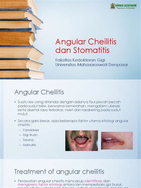 Angular Cheilitis Dan Stomatitis Pdf