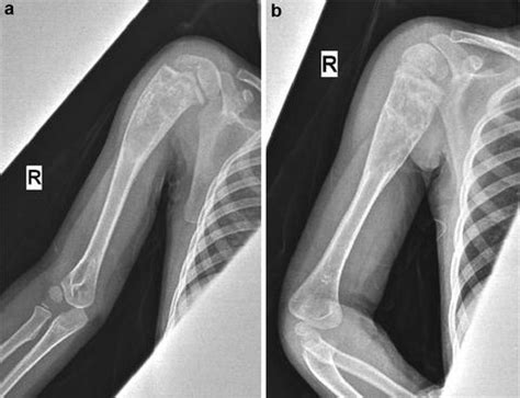 Distal Humeral Shaft Fracture