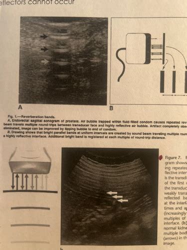 Artifacts Ultrasound Physics Flashcards Quizlet