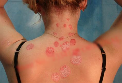 Natural Chinese Herbs Herbal Psoriasis Dermatitis Eczema Treatment