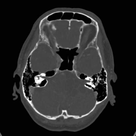 Cystic Acoustic Schwannoma Image Radiopaedia Org