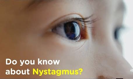 Nystagmus Types Causes Symptoms Treatment Exercise